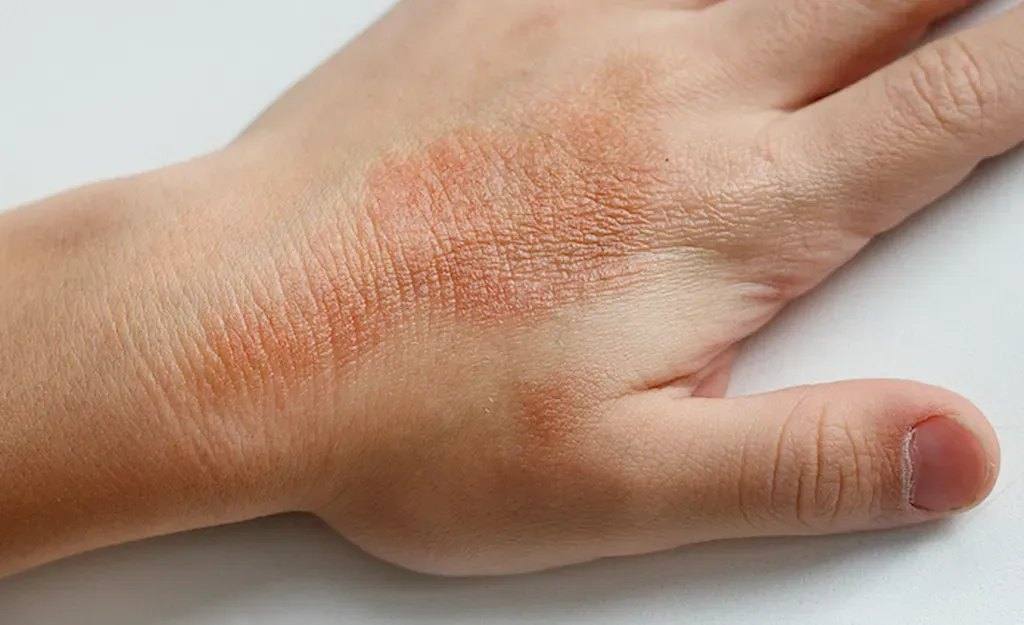 5 Common Eczema Triggers