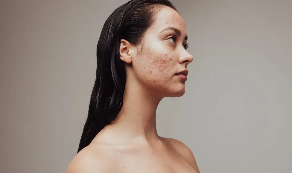 Adult Acne or Rosacea? How to tell the difference