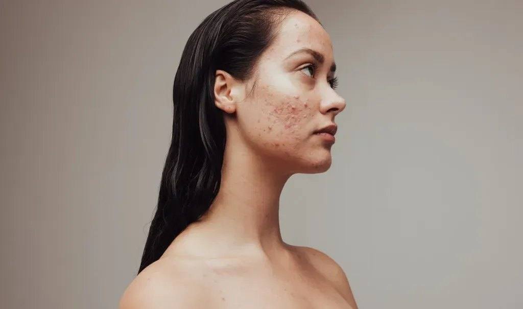 Adult Acne or Rosacea? How to tell the difference — kalon Dermatology