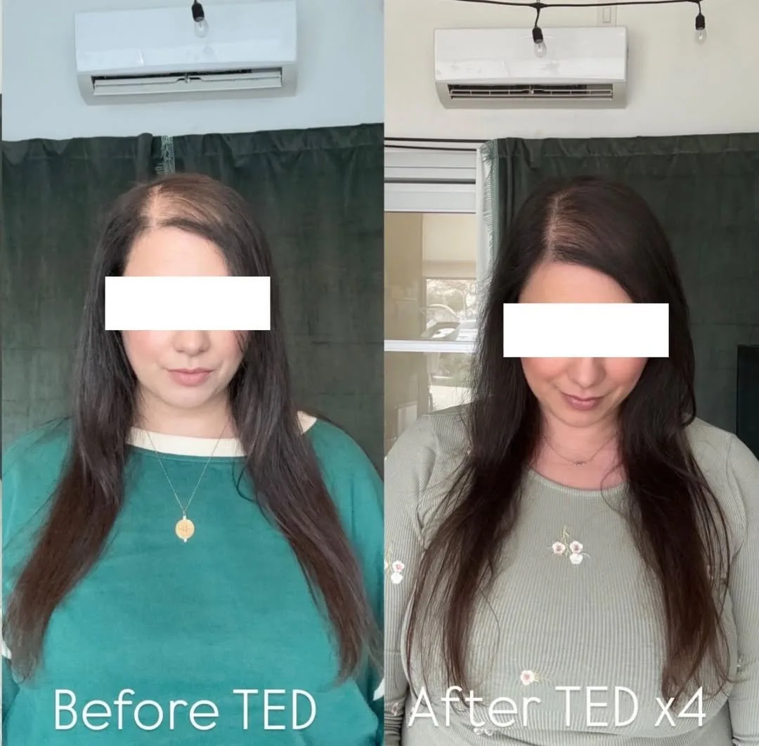 Alma TED hair restoration before and after at kalon Dermatology