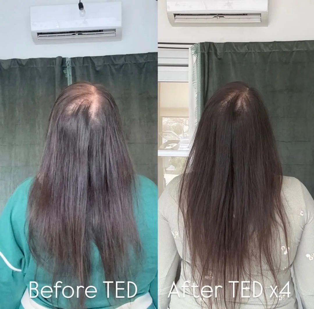 Alma TED hair restoration before and after at kalon Dermatology