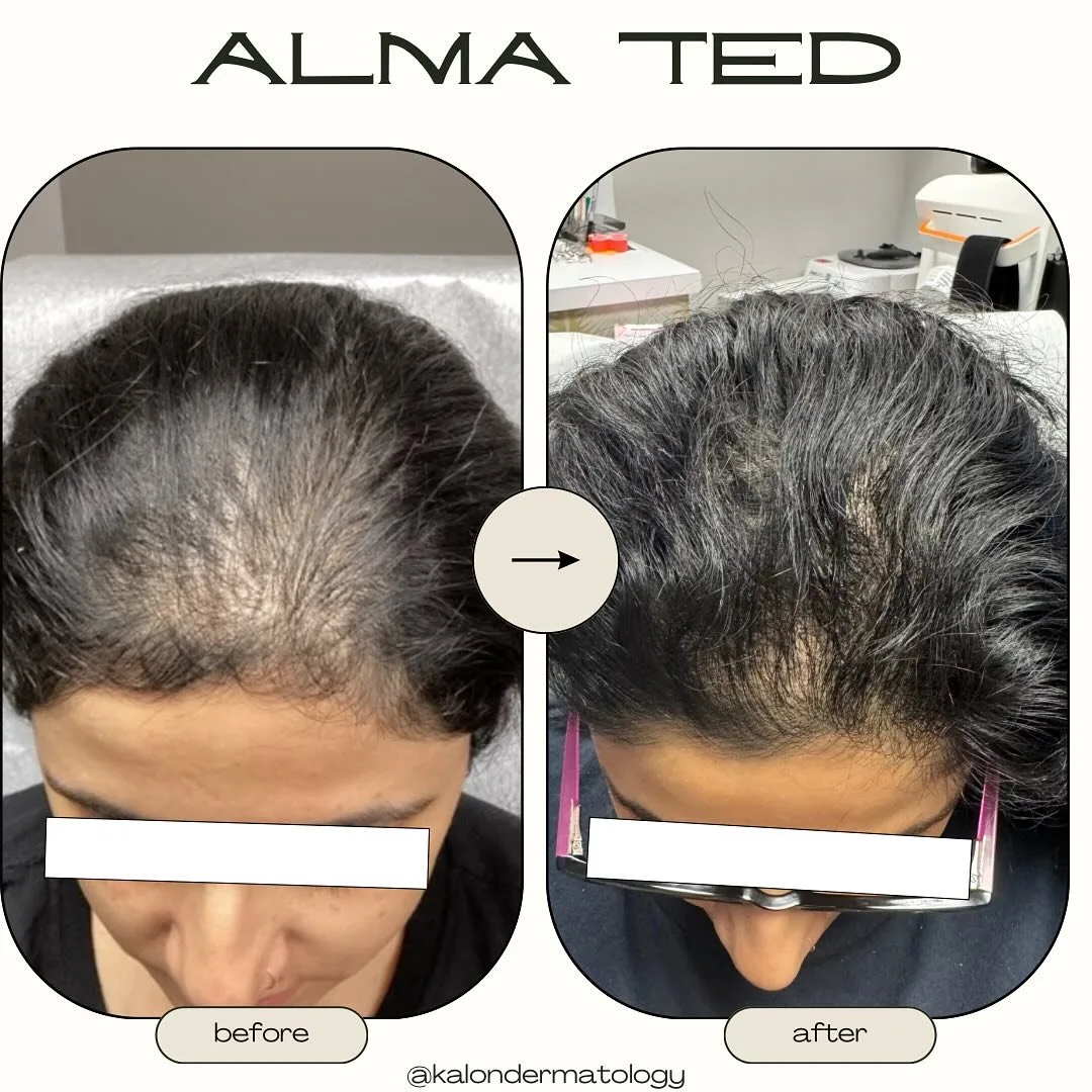Alma TED hair restoration before and after at kalon Dermatology