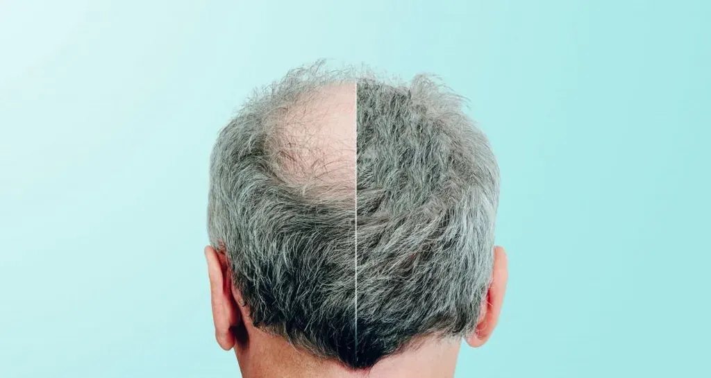 Alopecia Areata: Symptoms, Causes, and Available Treatments