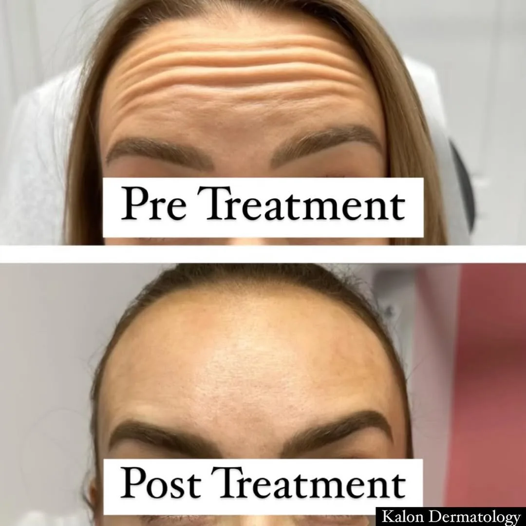 Botox before and after result at kalon Dermatology