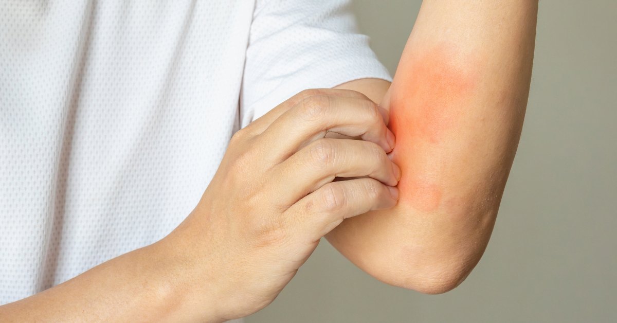 Can Anemia Cause a Rash? Symptoms Explained