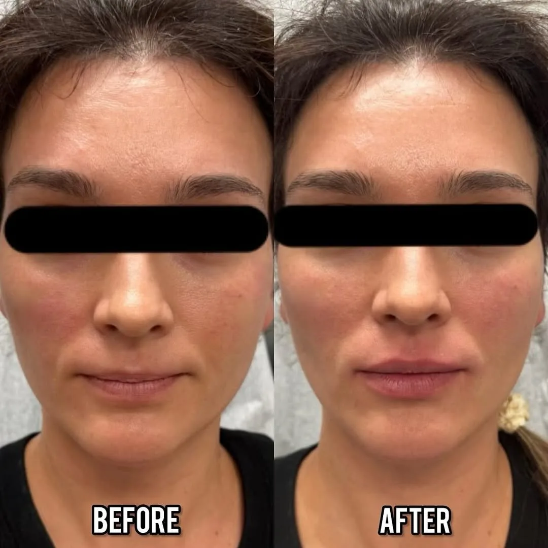 Dermal fillers before and after result at kalon Dermatology