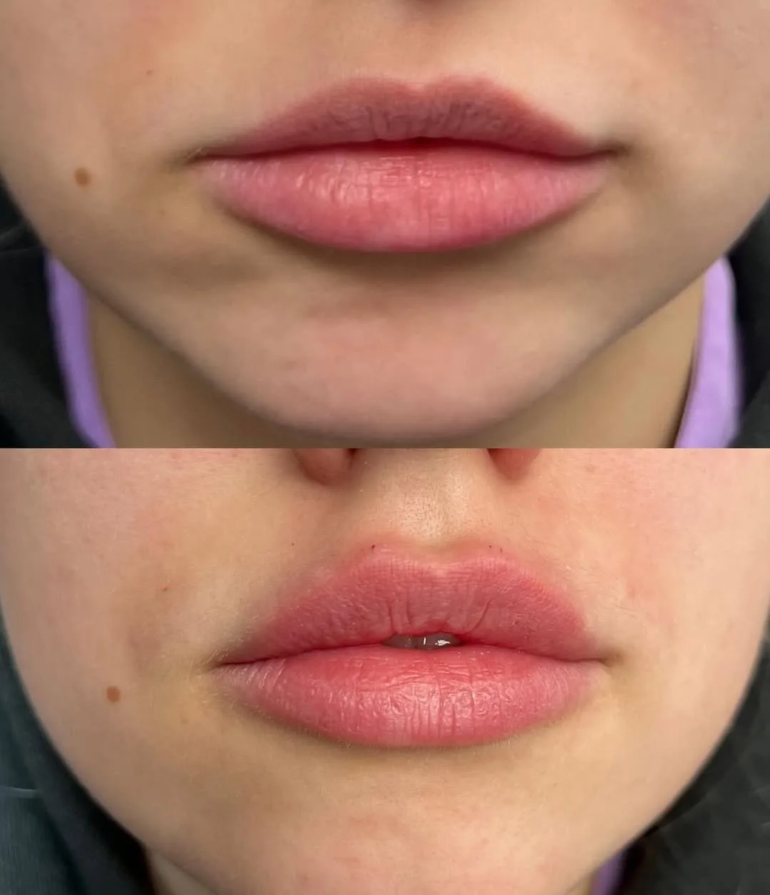 Dermal fillers before and after result at kalon Dermatology