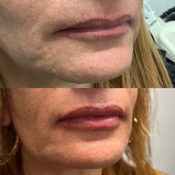 Dermal fillers before and after result at kalon Dermatology