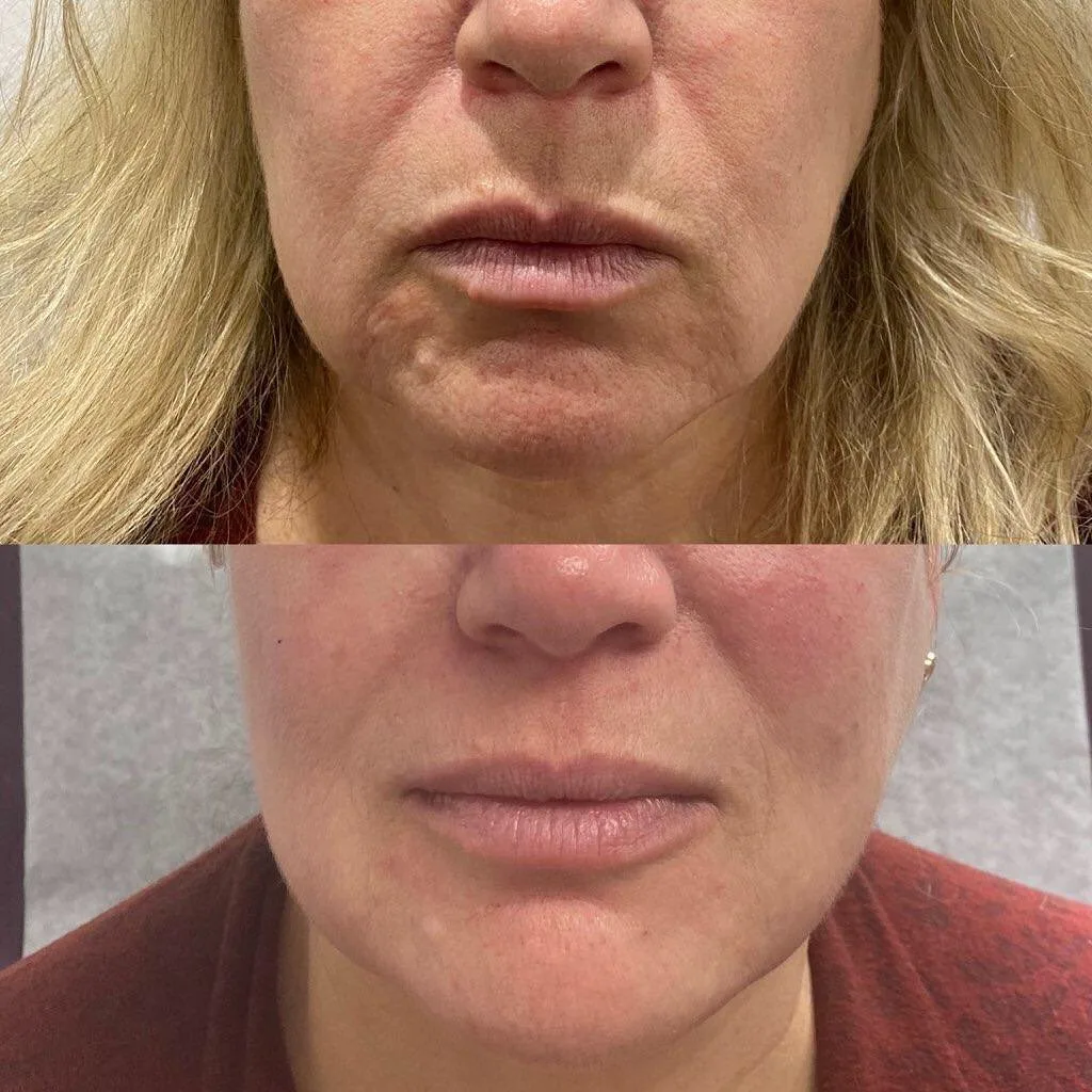 Dermal fillers before and after result at kalon Dermatology