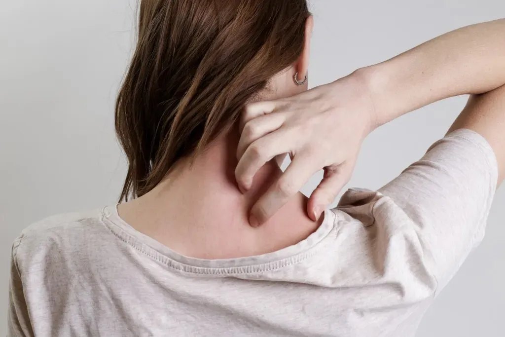 Home remedies to help avoid eczema triggers — kalon Dermatology