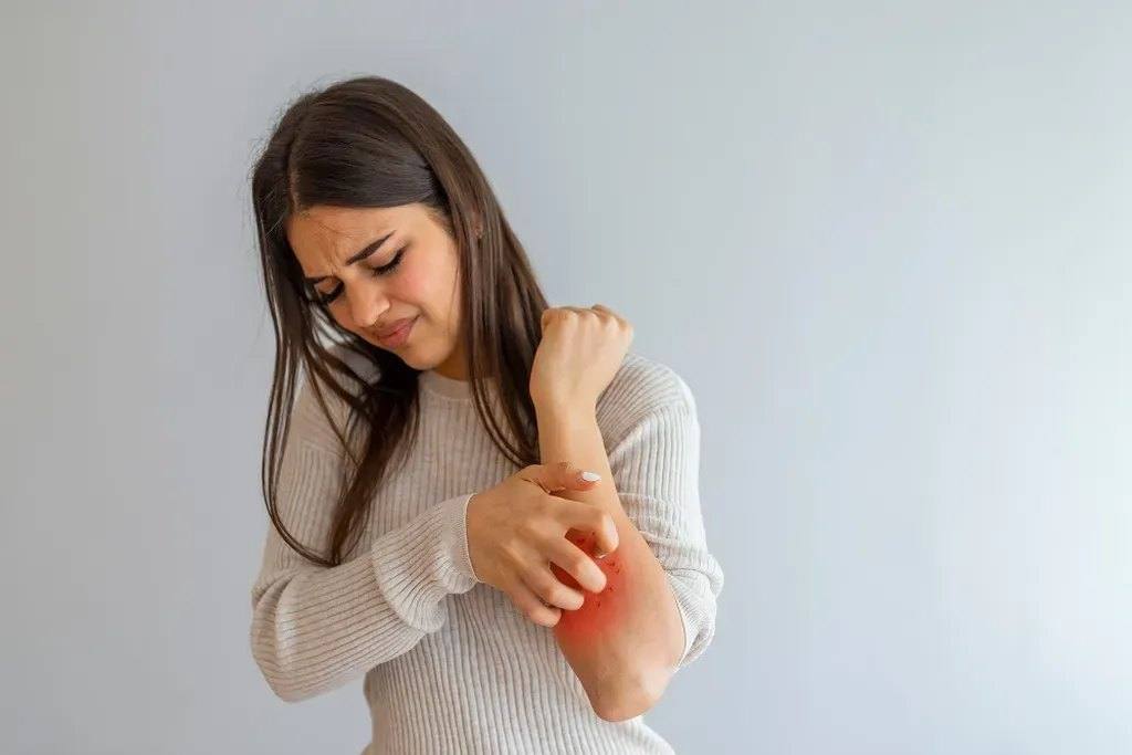 How does stress affect psoriasis?