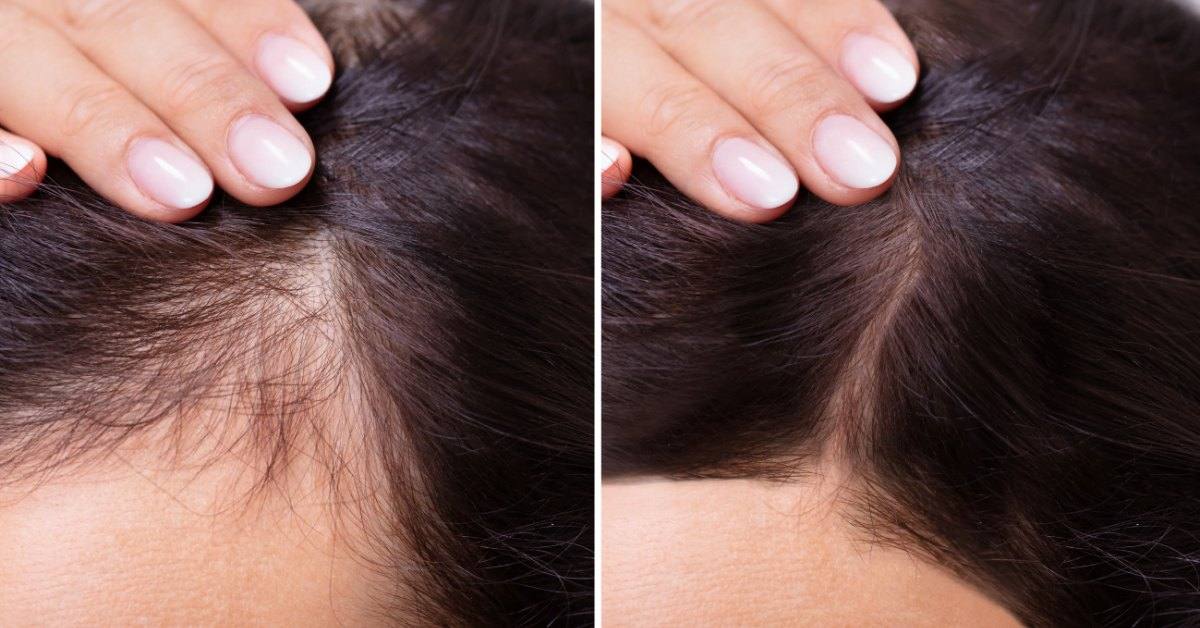 How long does the TED hair treatment last?