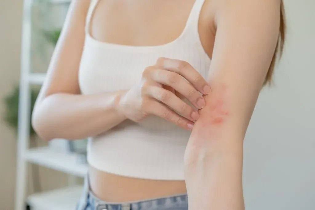 How to prevent a rosacea flare-up