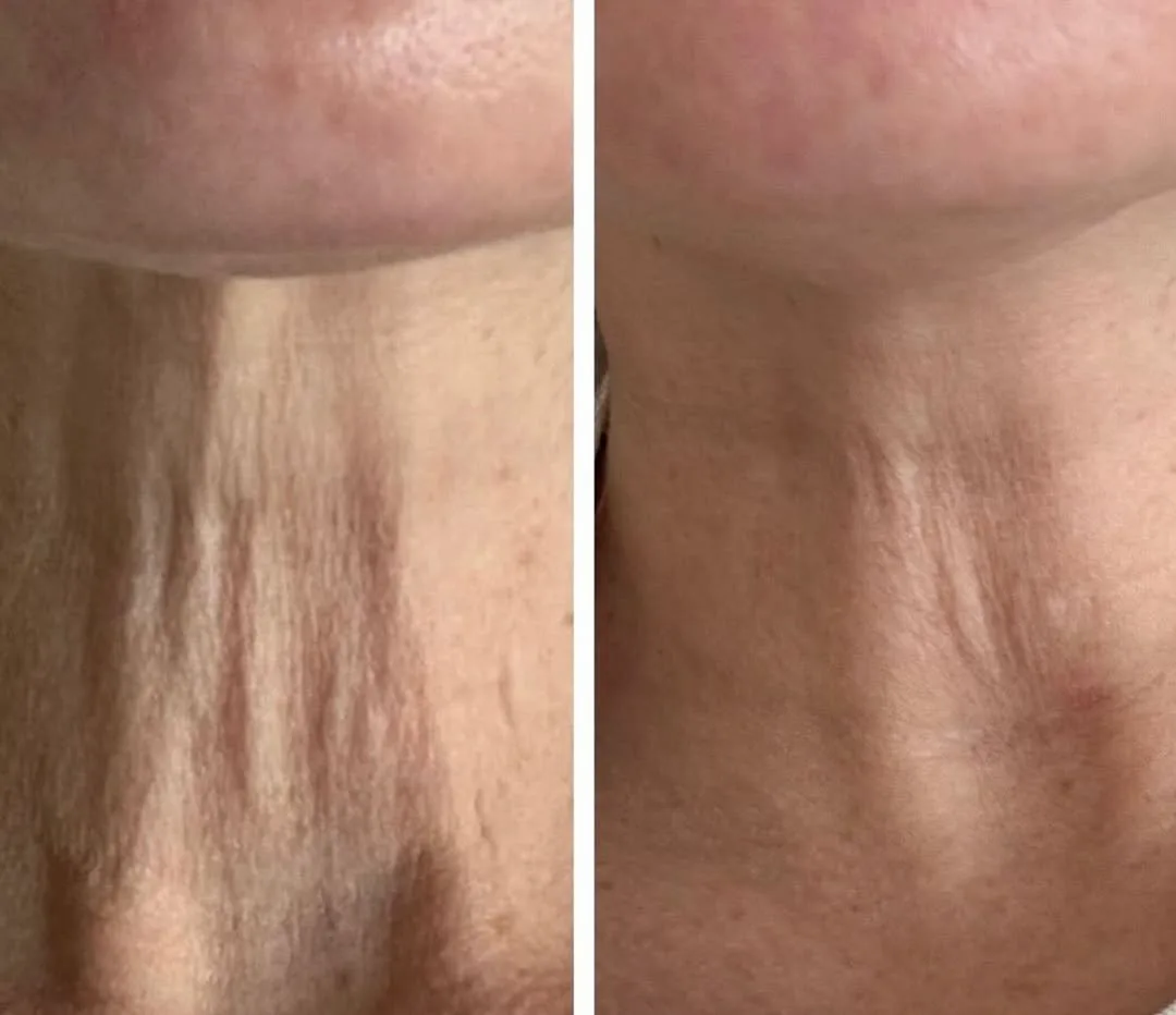SofWave skin tightening before and after at kalon Dermatology