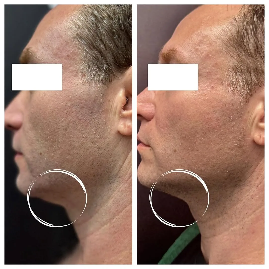 SofWave skin tightening before and after at kalon Dermatology