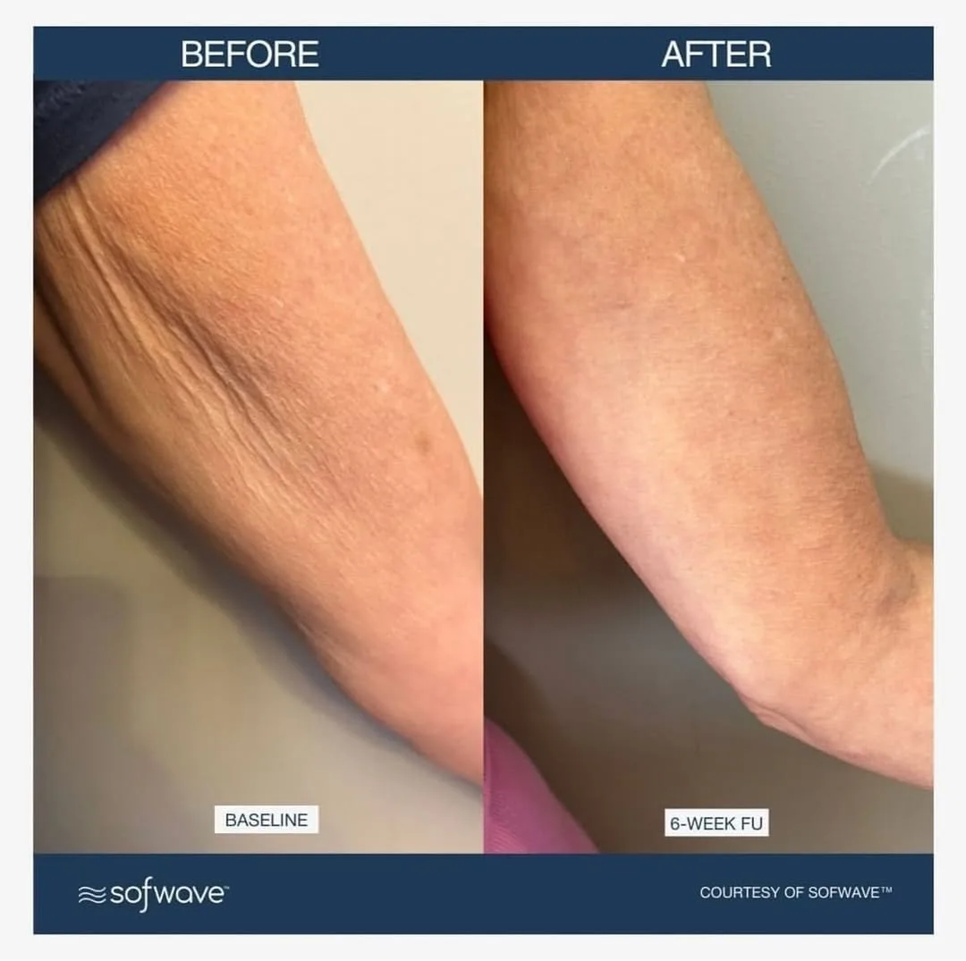 SofWave skin tightening before and after at kalon Dermatology
