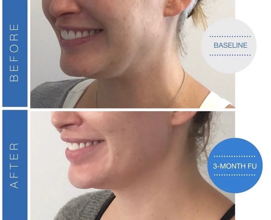 SofWave skin tightening before and after at kalon Dermatology
