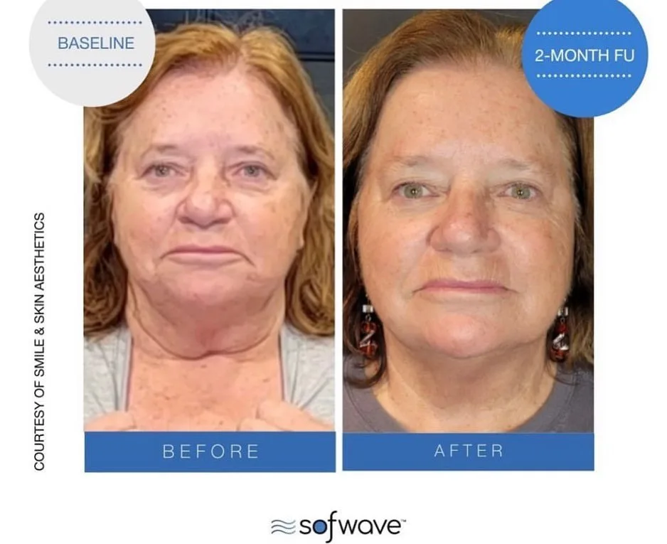 SofWave skin tightening before and after at kalon Dermatology