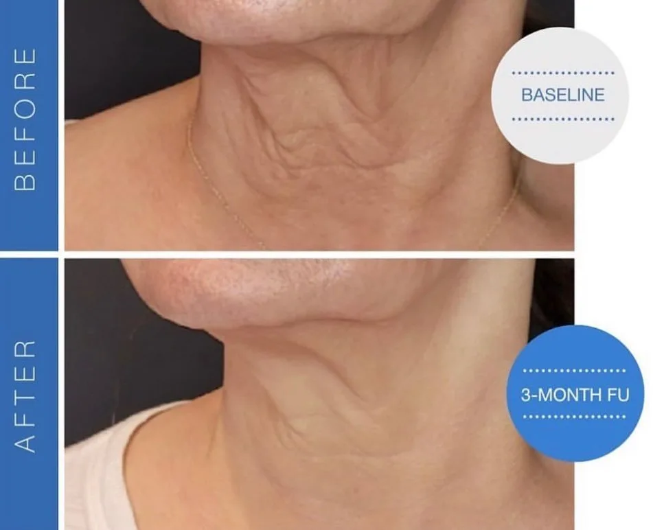 SofWave skin tightening before and after at kalon Dermatology