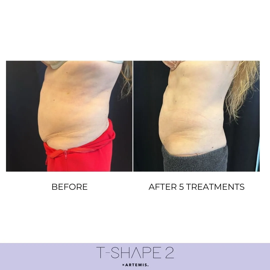 T-Shape body contouring before and after at kalon Dermatology