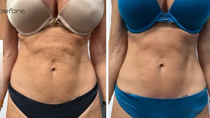 T-Shape body contouring before and after at kalon Dermatology