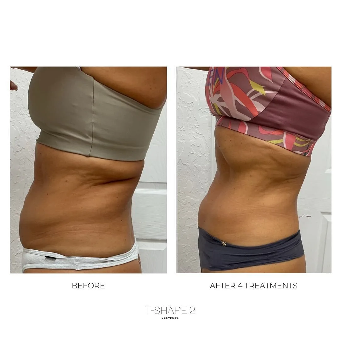 T-Shape body contouring before and after at kalon Dermatology