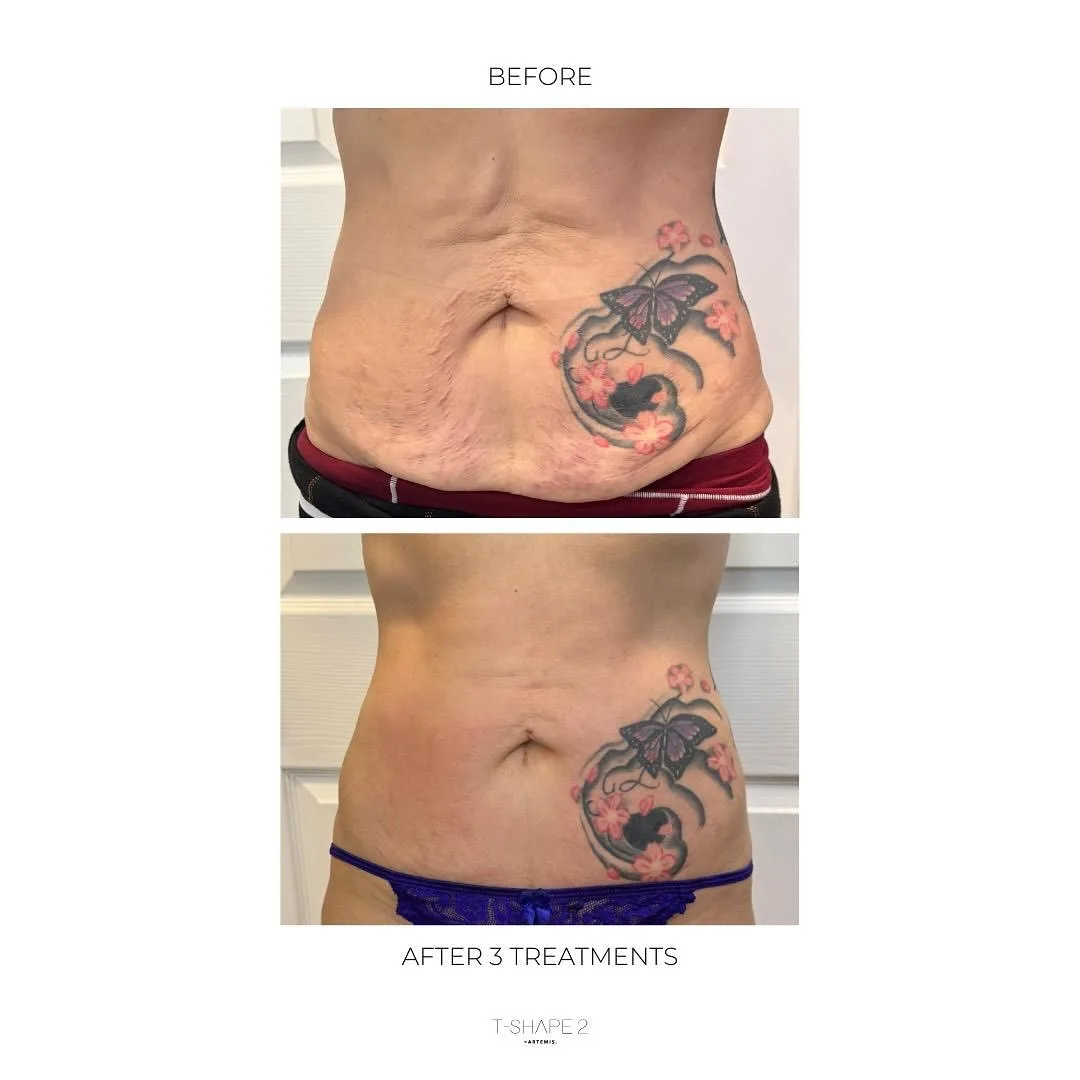 T-Shape body contouring before and after at kalon Dermatology