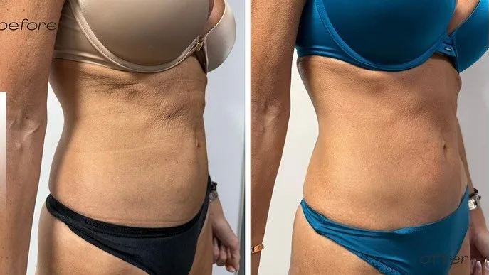 T-Shape body contouring before and after at kalon Dermatology