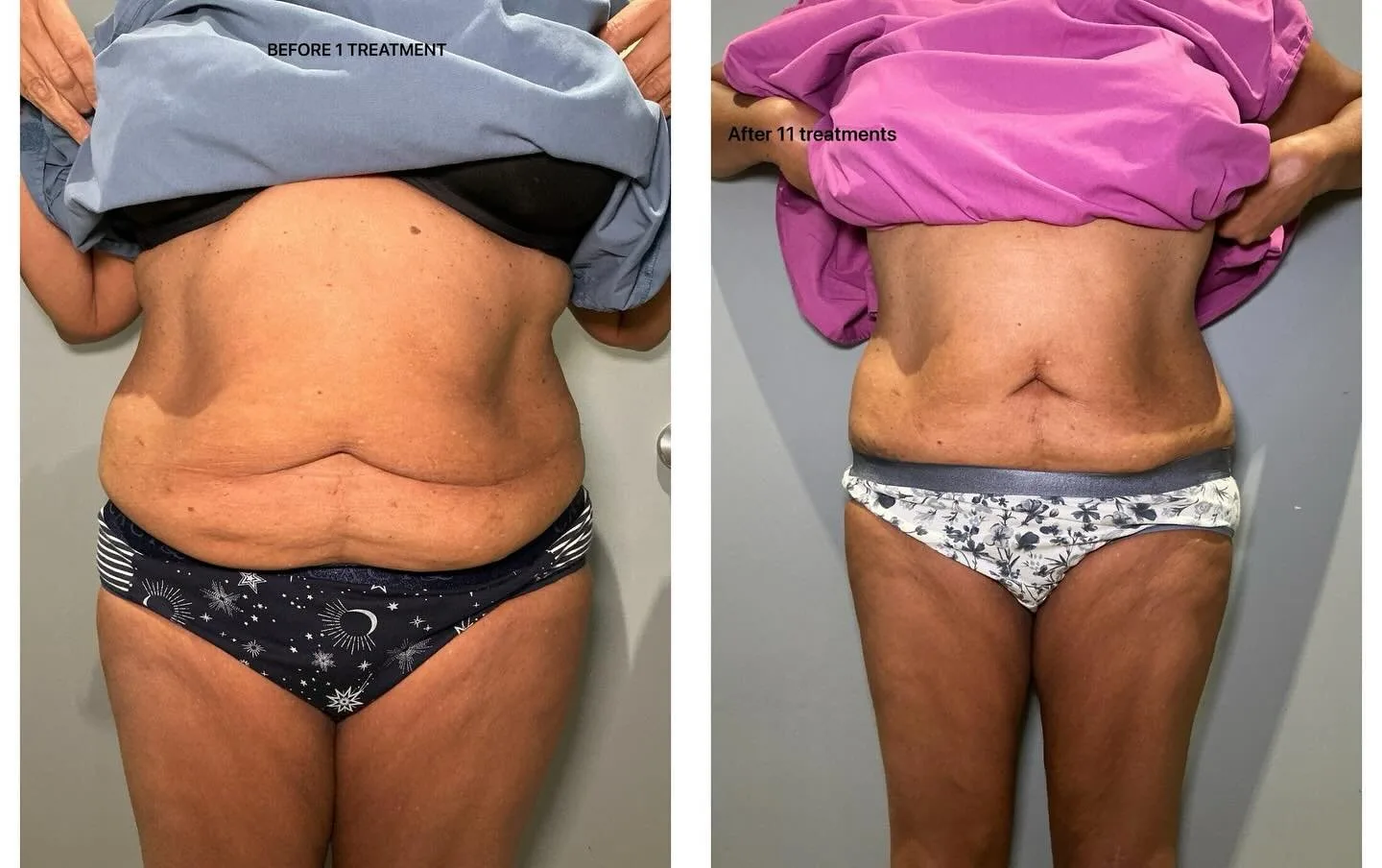 T-Shape body contouring before and after at kalon Dermatology