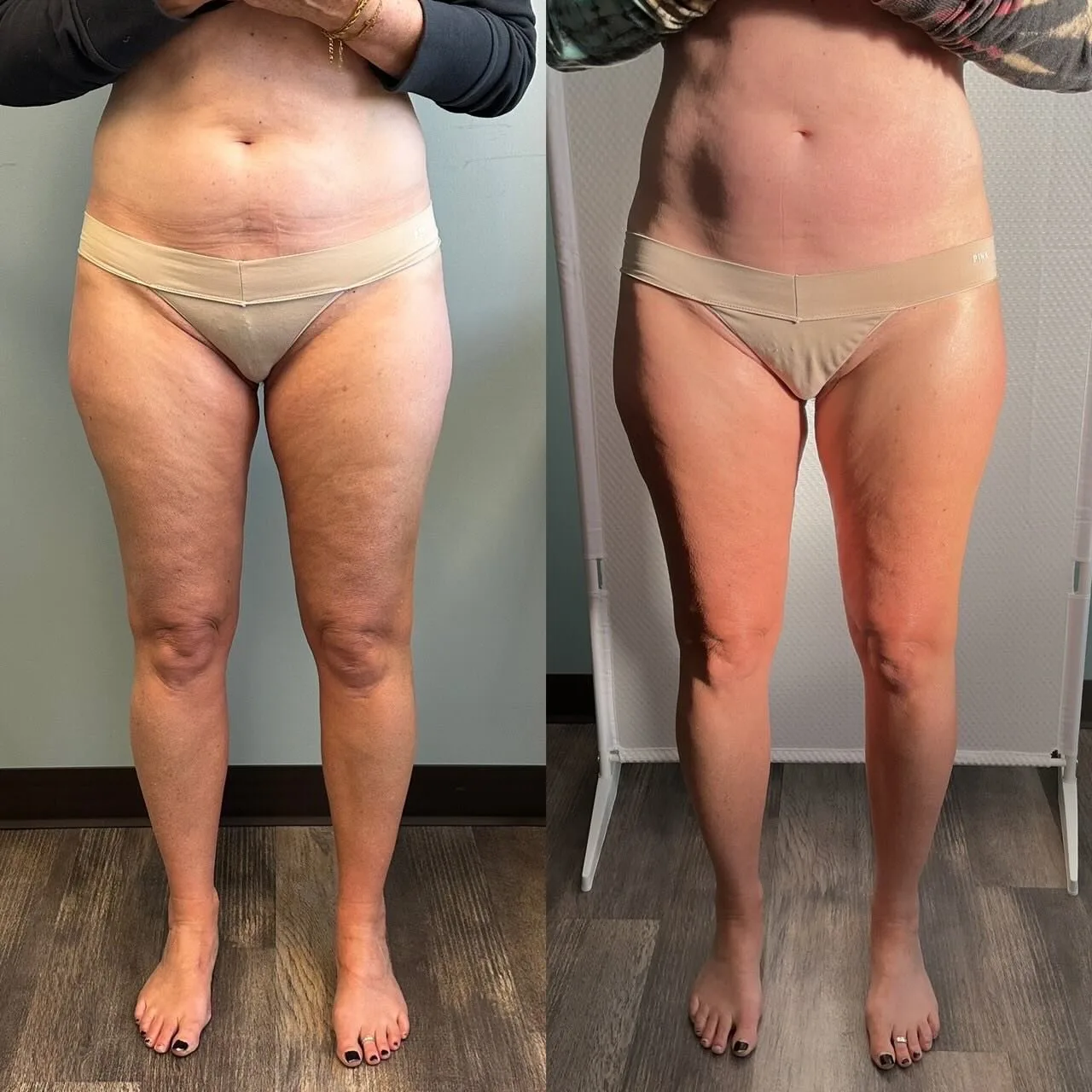 T-Shape body contouring before and after at kalon Dermatology