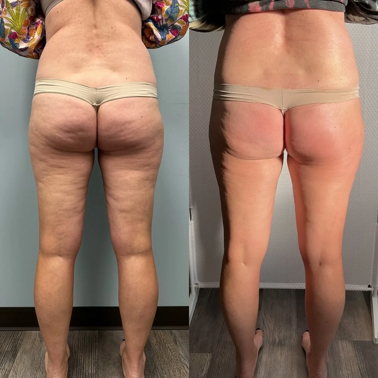 T-Shape body contouring before and after at kalon Dermatology