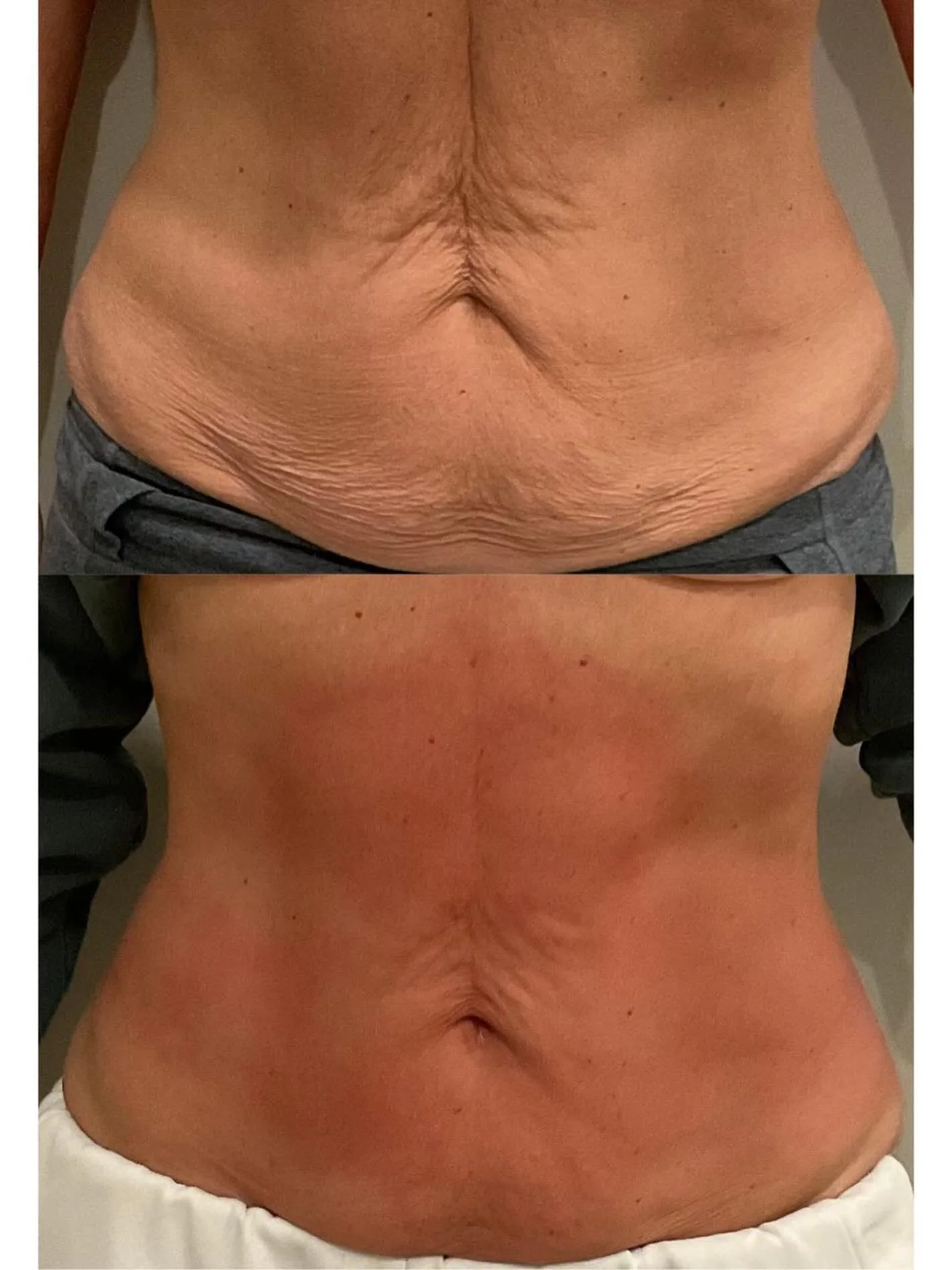 T-Shape body contouring before and after at kalon Dermatology