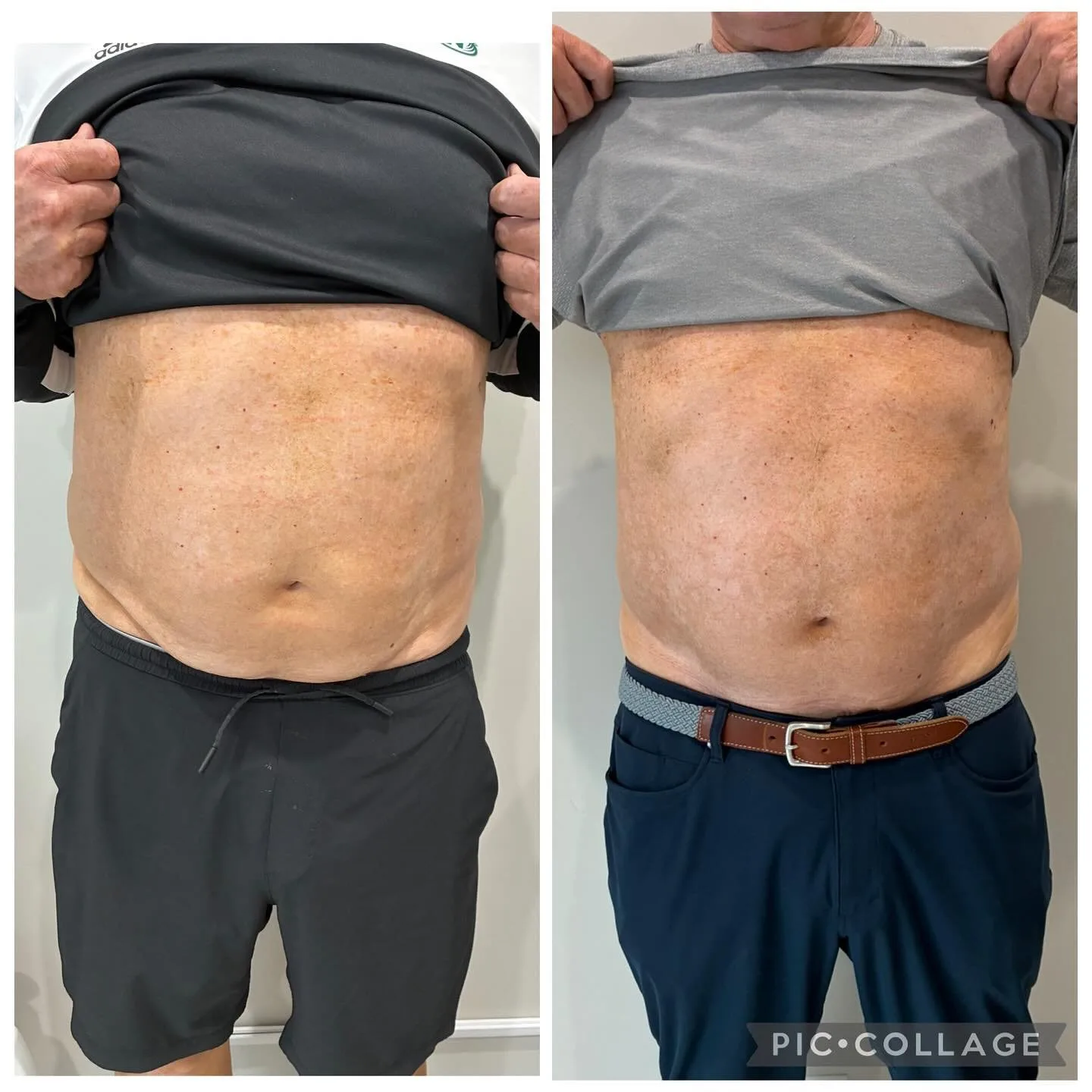 T-Shape body contouring before and after at kalon Dermatology