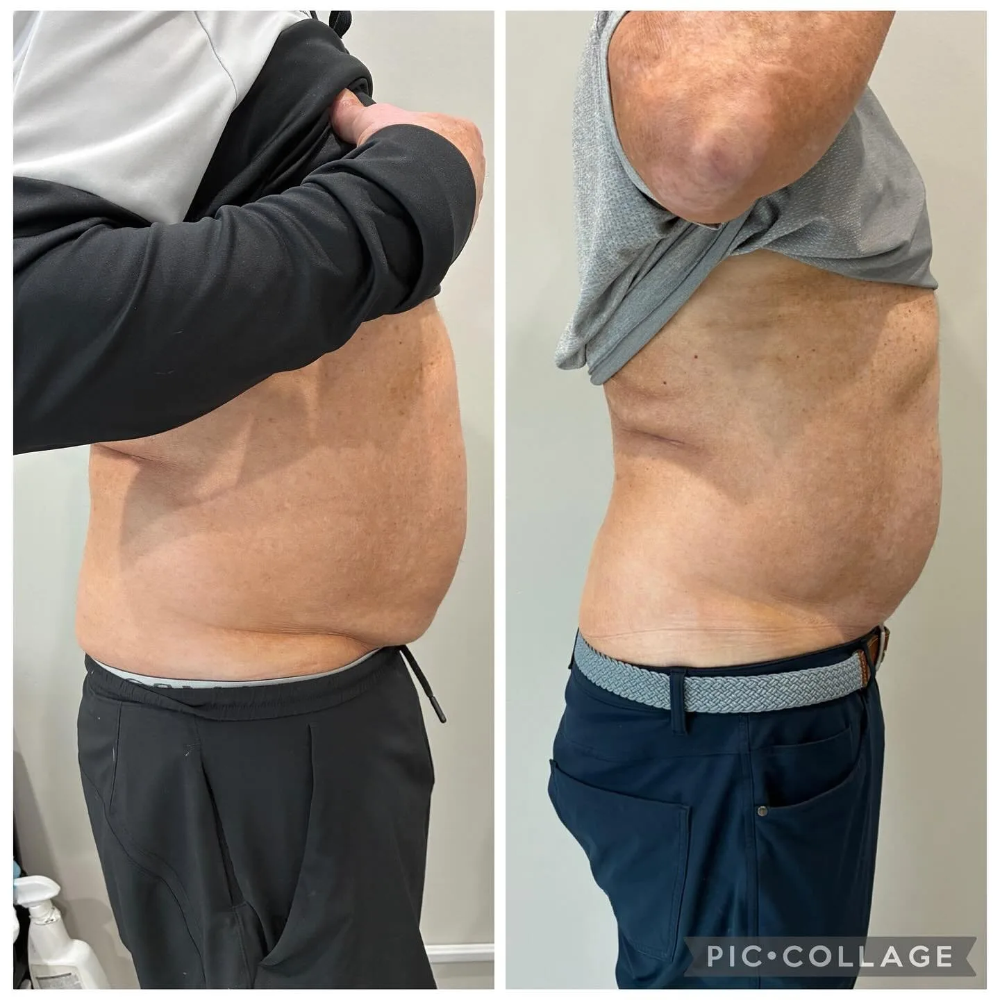 T-Shape body contouring before and after at kalon Dermatology