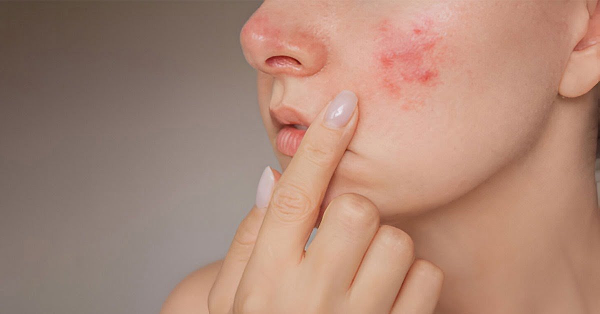 Why Do Pre-Workout Supplements Cause Acne? A Complete Overview