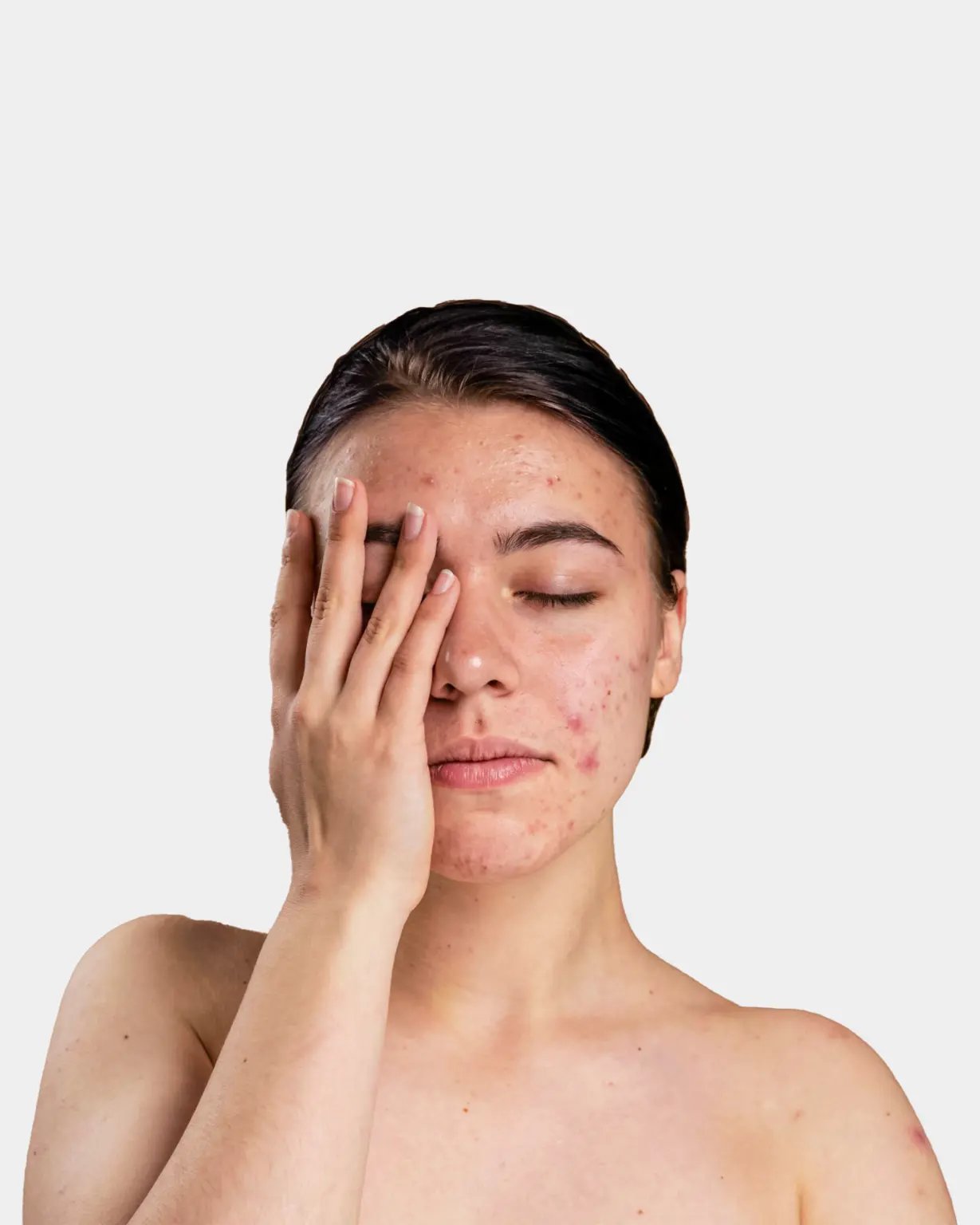 ¿Cuándo debo buscar atención dermatológica para el acné?