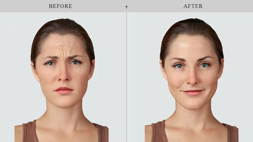 Botox en Brooklyn antes y despues en kalon Dermatology