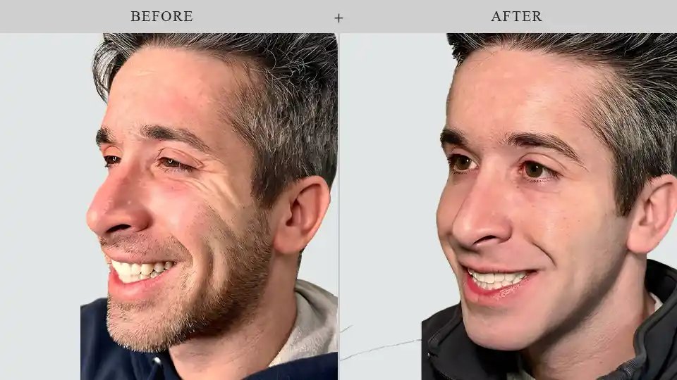 Botox en Brooklyn antes y despues en kalon Dermatology