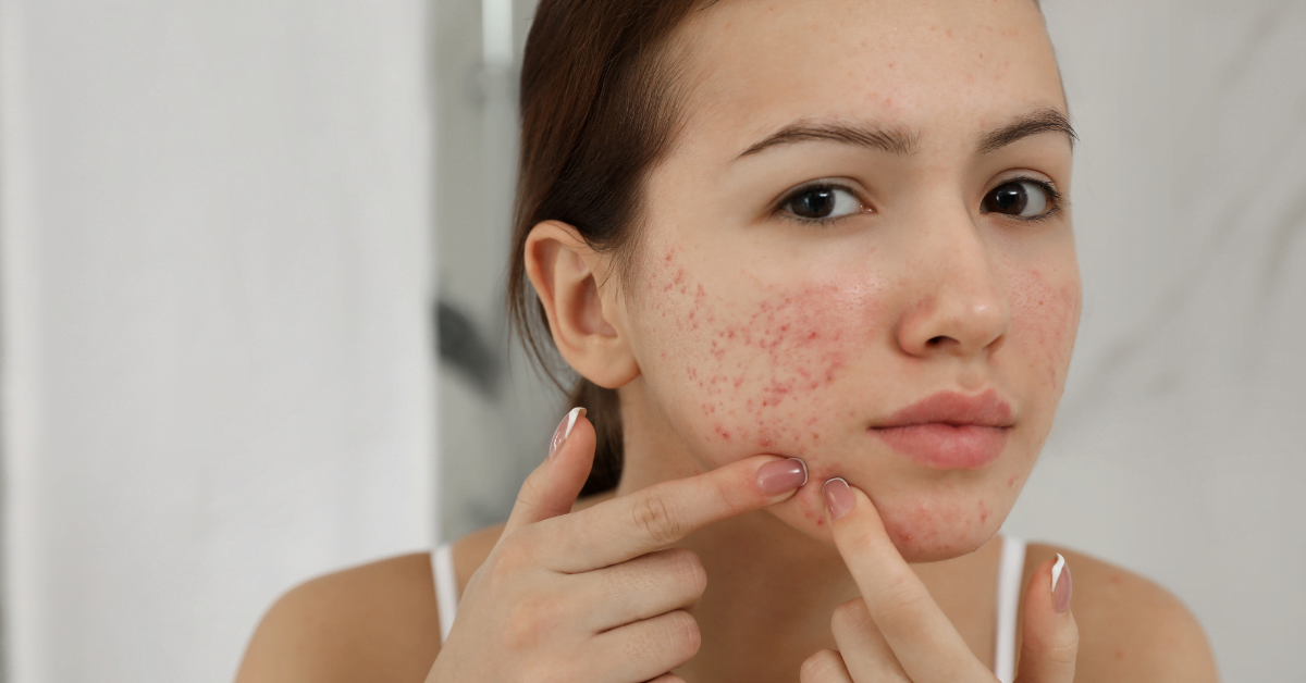 Can collagen cause acne