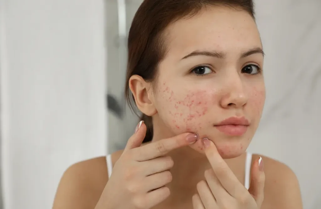 What Are the Most Common Acne Lesions