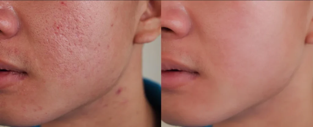 Do Facials Help Acne?