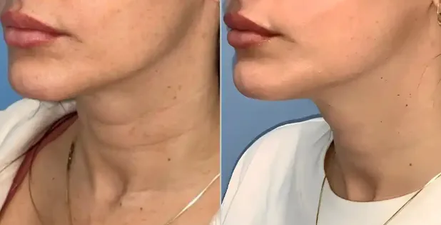 How to Tighten Loose Skin After Weight Loss Without Surgery