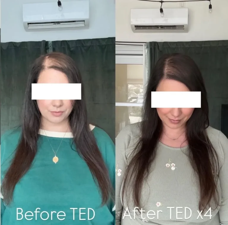 Alma TED hair restoration before and after - kalon Dermatology Brooklyn