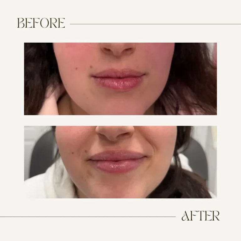Filler before and after Patient 1 results - kalon Dermatology Brooklyn
