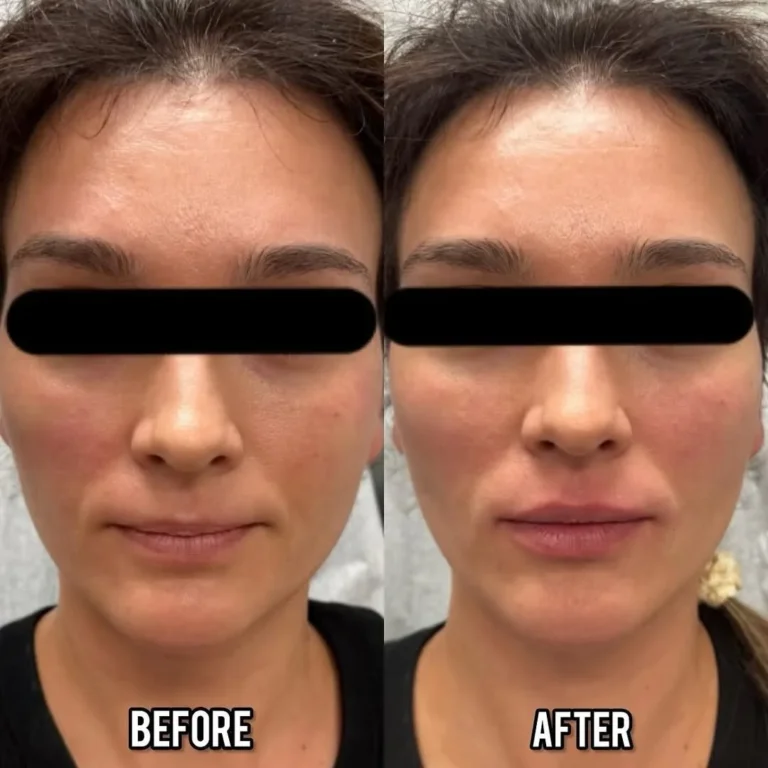 Filler before and after Patient 2 results - kalon Dermatology Brooklyn