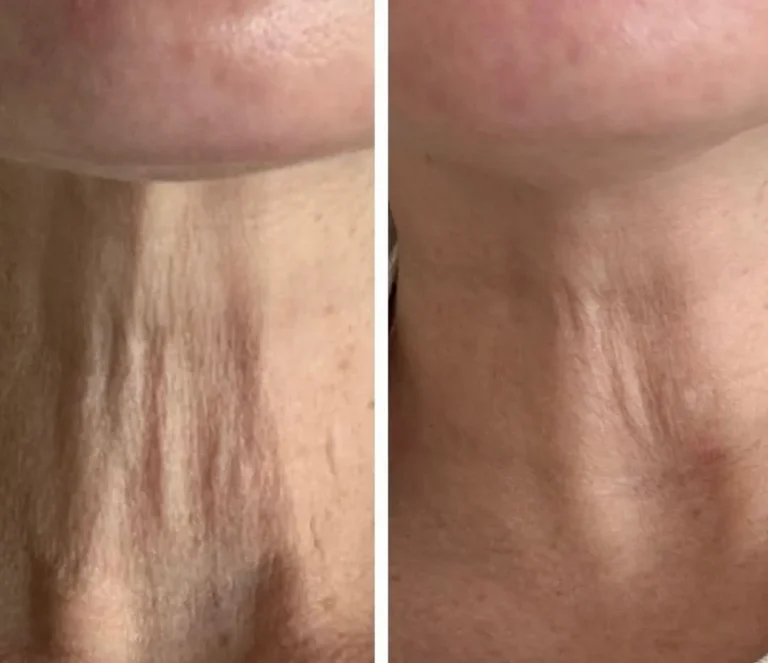 Sofwave before and after Patient 1 results - kalon Dermatology Brooklyn