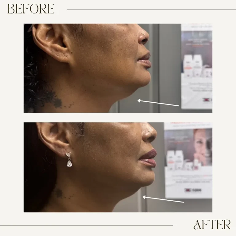 Sofwave before and after Patient 2 results - kalon Dermatology Brooklyn
