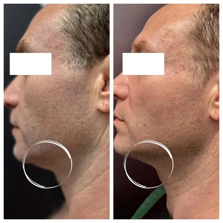 Sofwave before and after Patient 3 results - kalon Dermatology Brooklyn