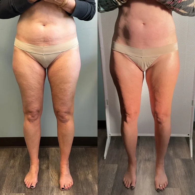 T-Shape 2 body contouring before and after - kalon Dermatology Brooklyn