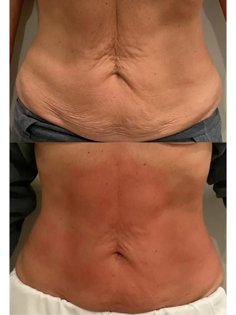 T-Shape 2 body contouring before and after - kalon Dermatology Brooklyn